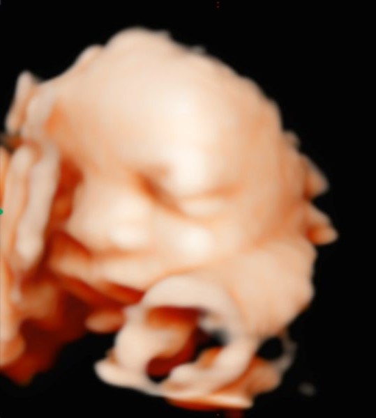 ecografia-5d-mostoles